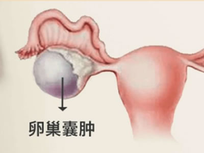 卵巢囊腫會癌變？！不用慌，注意事項在這里