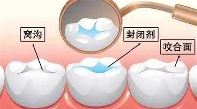 【口腔知識(shí)】帶您了解窩溝封閉